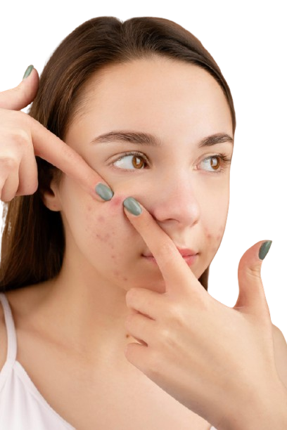 Acne Scar Treatment