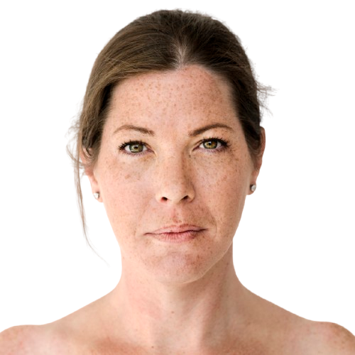 Pigmentation Treatment