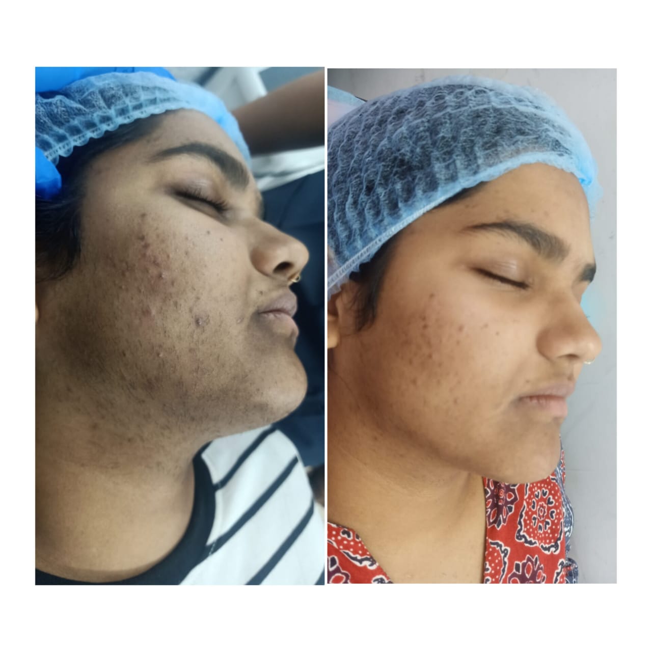 Pigmentation Treatment