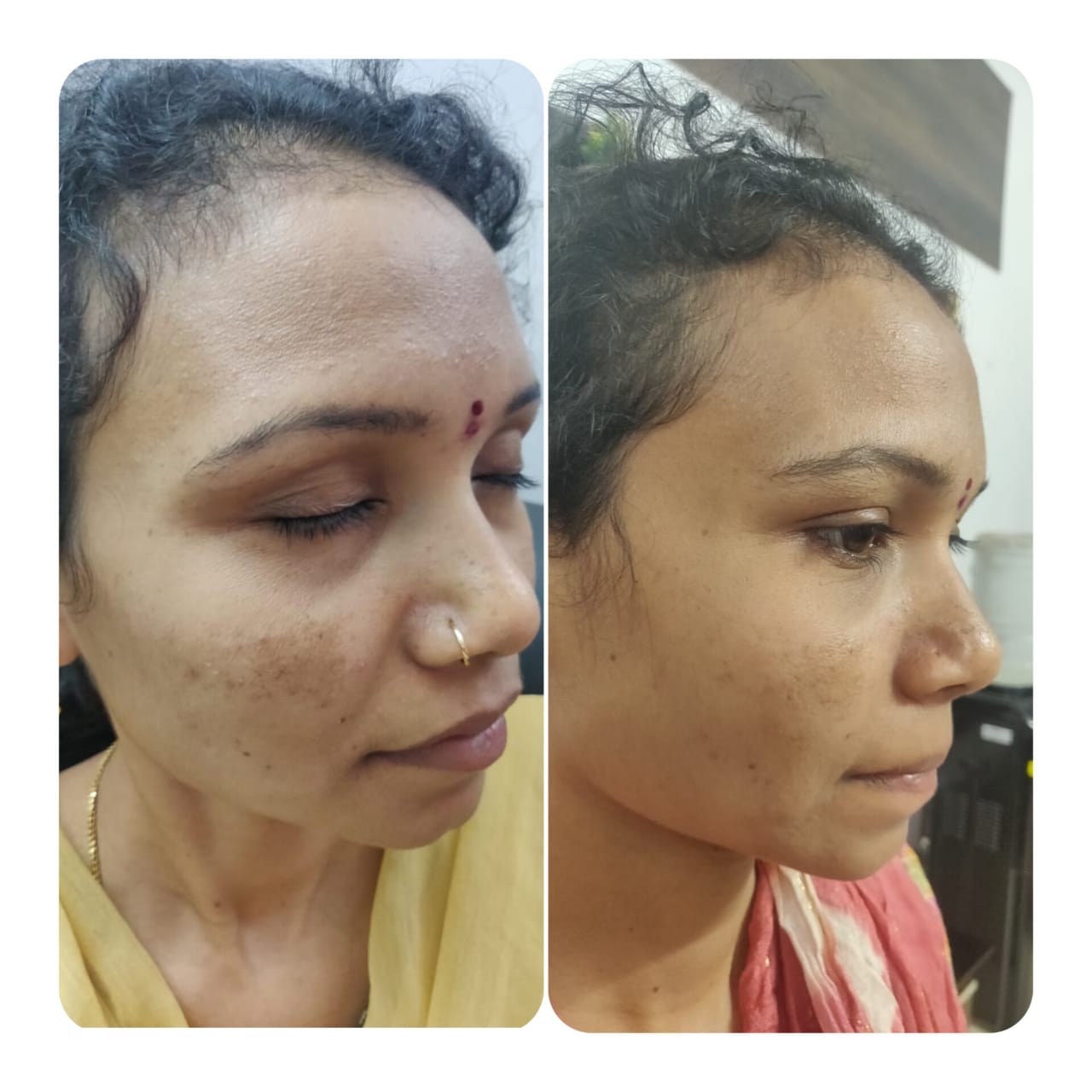 Laser Hair Reduction