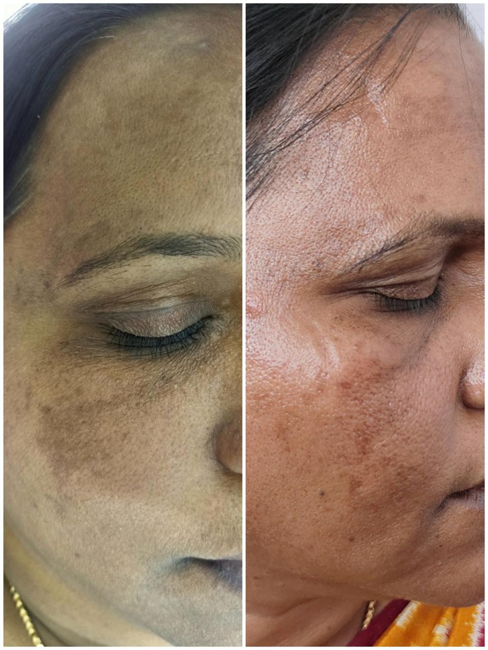 Dark Circles Treatment