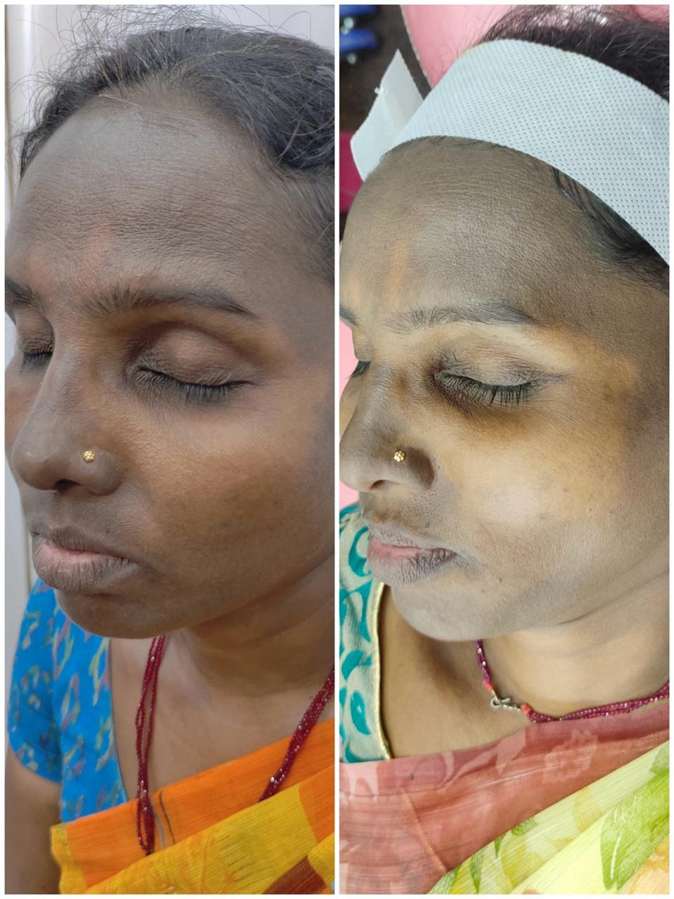 Pigmentation Treatment