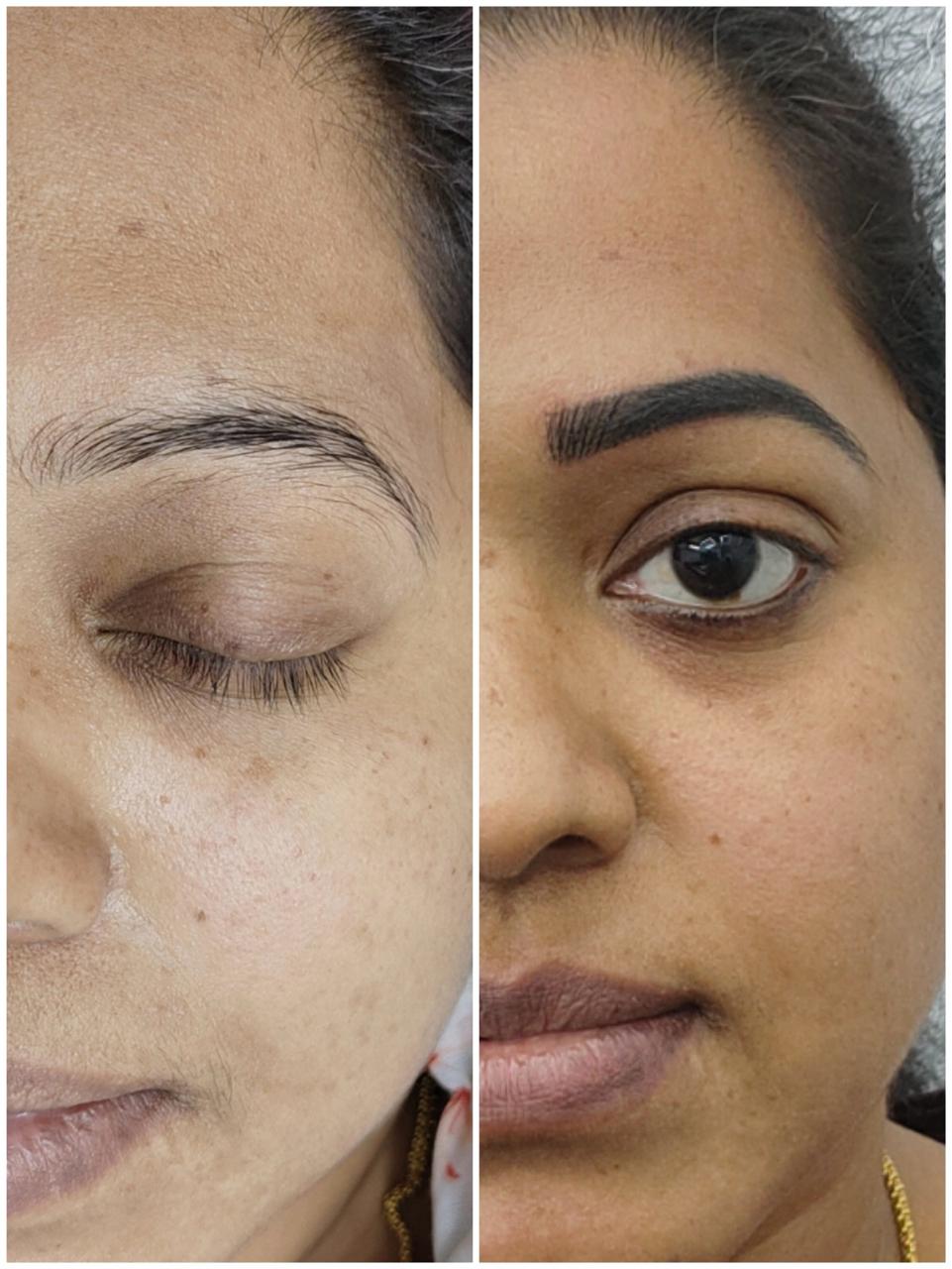 Laser Hair Reduction