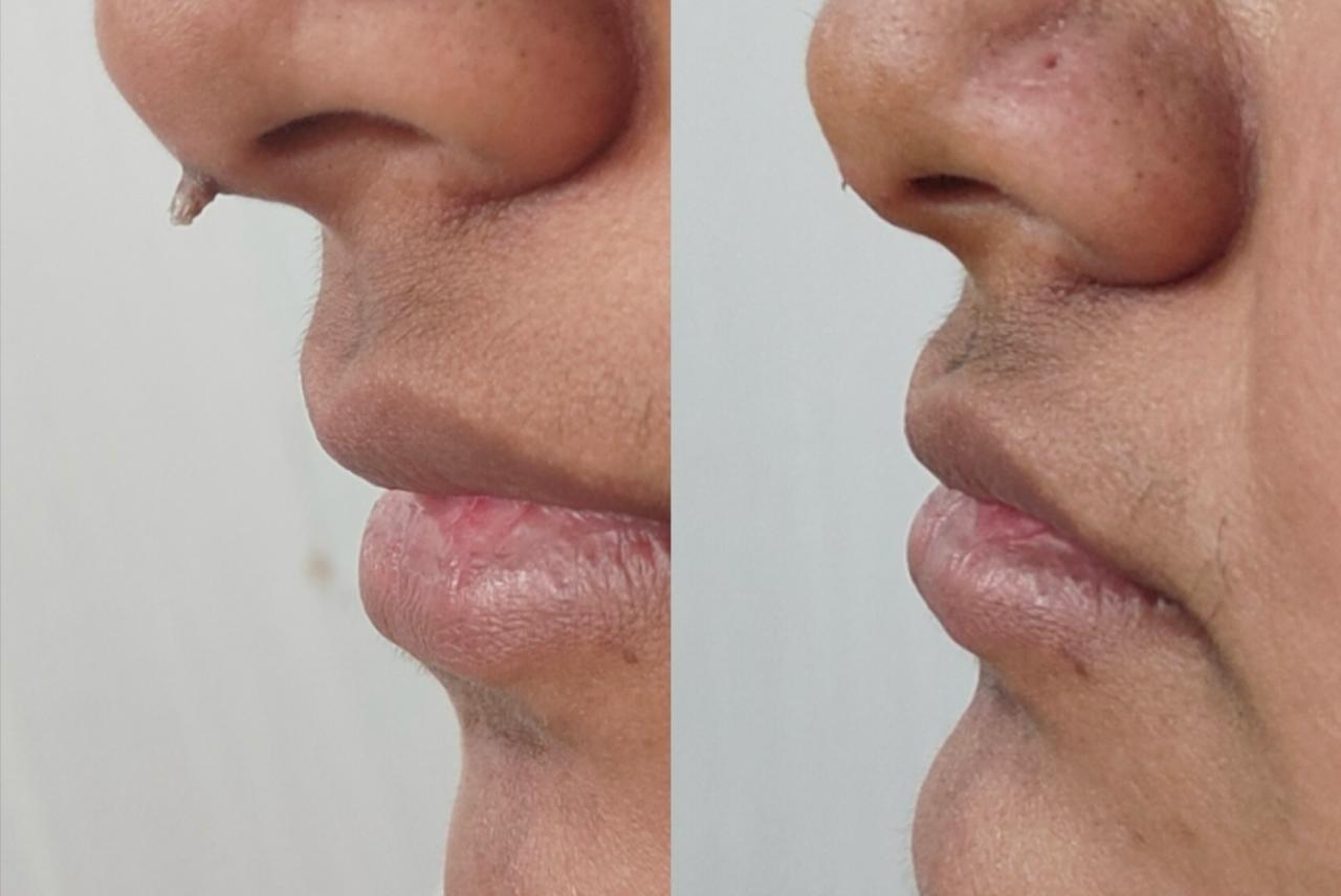 Hydra Facial