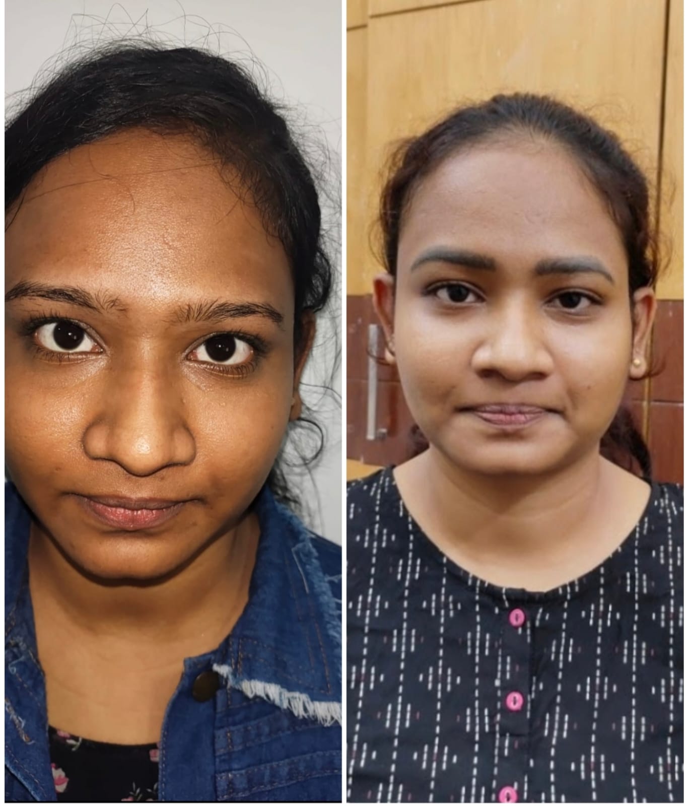 Dark Circles Treatment