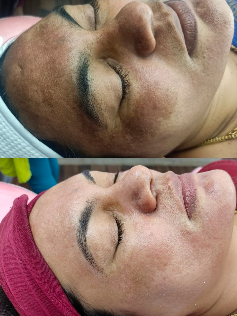 Pigmentation Treatment